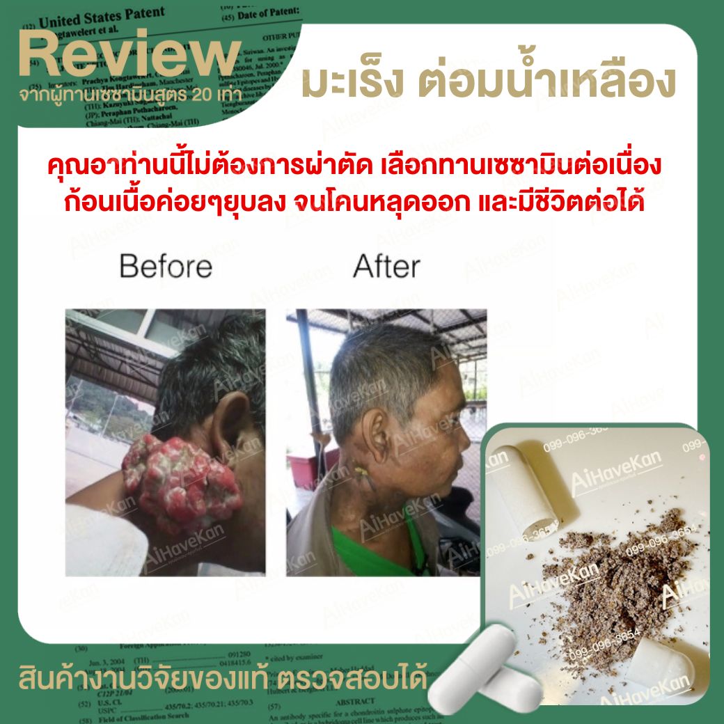เซซามิน มะเร็งต่อมน้ำเหลือง